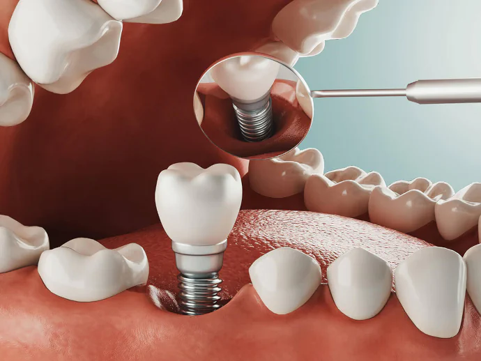 Dental implants in Westfield and Cranford, NJ at The Dental Family.