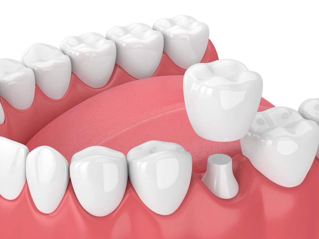 illustration of a dental crown being placed on the bottom row of teeth