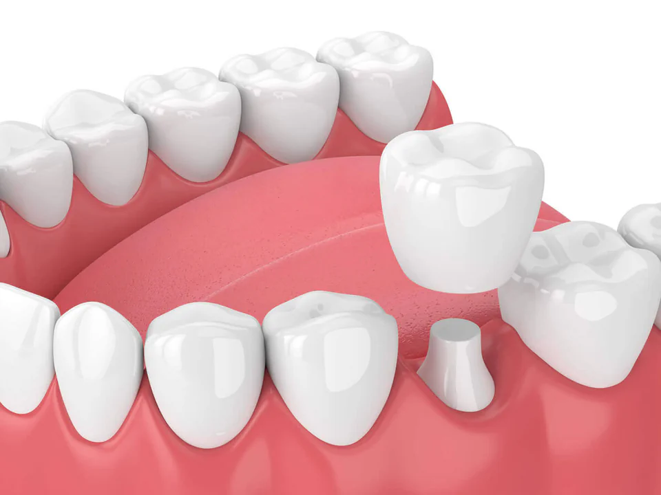 Dental crowns and dental bridges in Westfield and Cranford, NJ at The Dental Family.