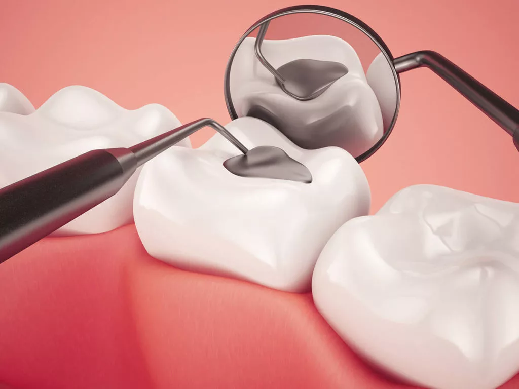3D illustration of a dental filling applied to a molar, demonstrating a tooth restoration procedure