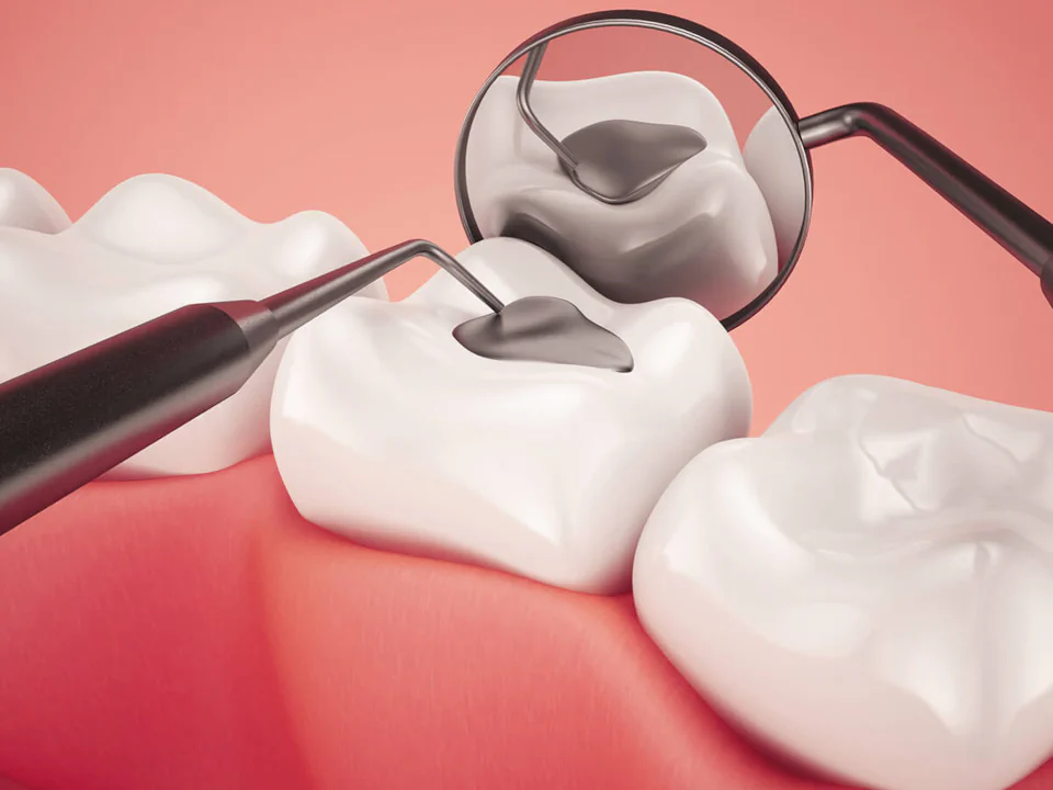 Dental fillings and dental sealants in Westfield and Cranford, NJ at The Dental Family.