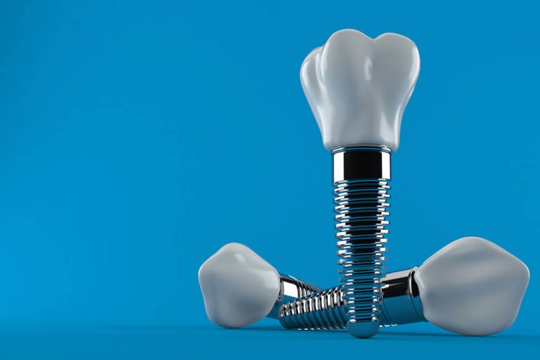 Three dental implants with tooth crowns on a blue background. One implant is standing upright while the other two are lying down, showcasing the metal screw and ceramic crown structure.