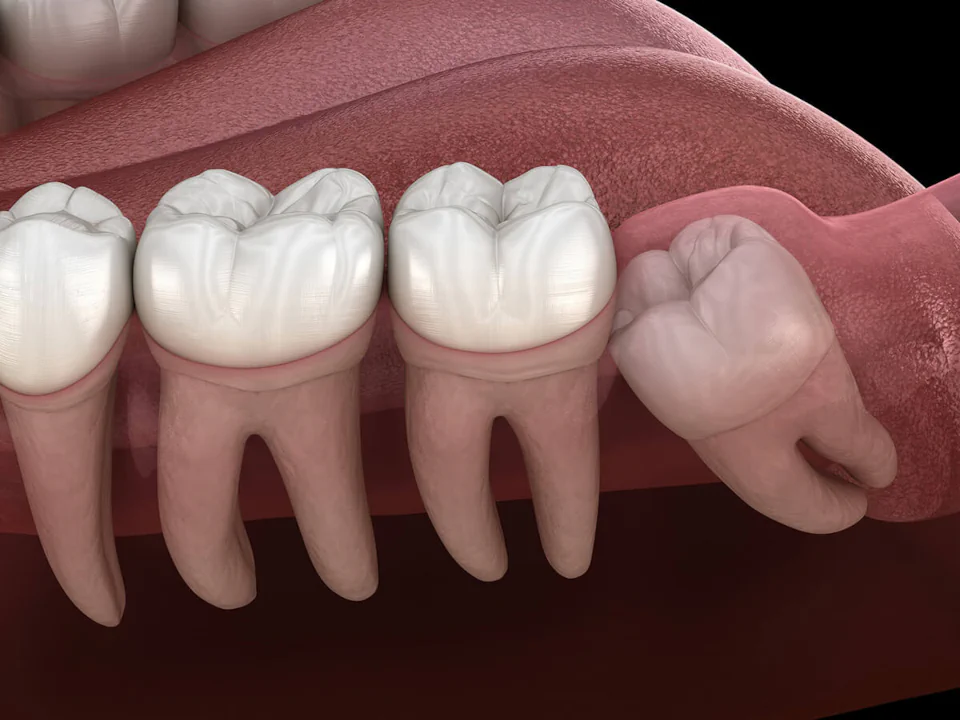 Wisdom teeth removal in Westfield and Cranford, NJ at The Dental Family.