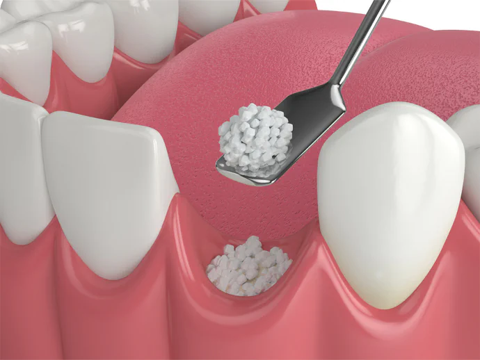 Dental bone grafting in Westfield and Cranford, NJ at The Dental Family.