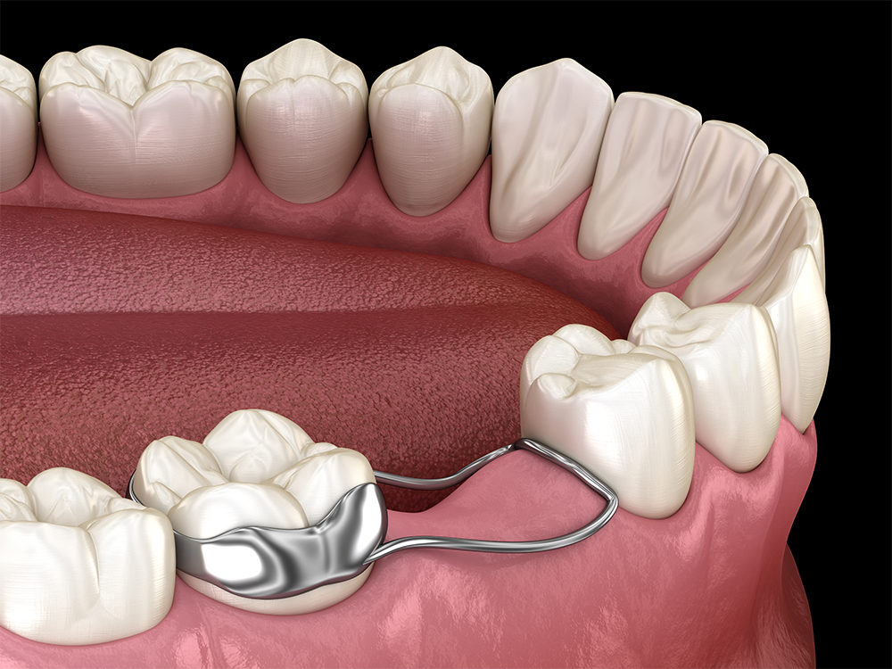 bottom row of teeth using a dental space maintainer