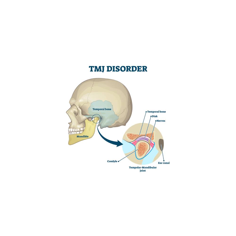 TMJ disorder vector illustration. Labeled jaw condition educational scheme.