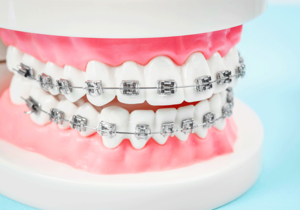 metal braces on a dental cast