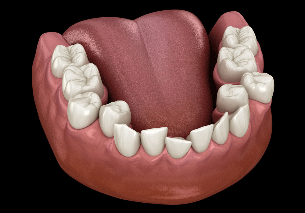 Teeth Crowding 3D illustration